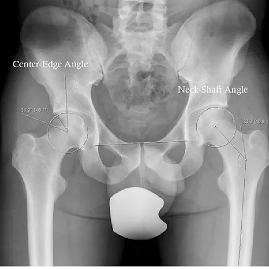 X-Ray Pelvis AP View Procedure